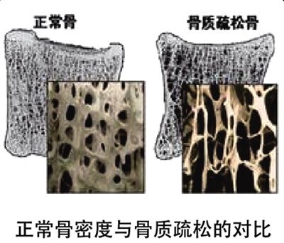 骨密度儀品牌為您分析導致骨質疏松的其他因素