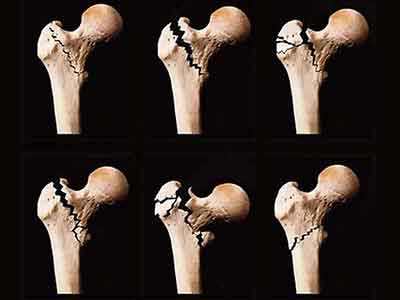 骨密度儀廠家告訴您常見骨質(zhì)硫松性骨折的臨床表現(xiàn)